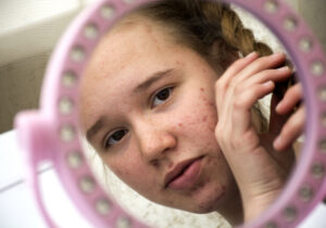 teen girl with acne looks in mirror